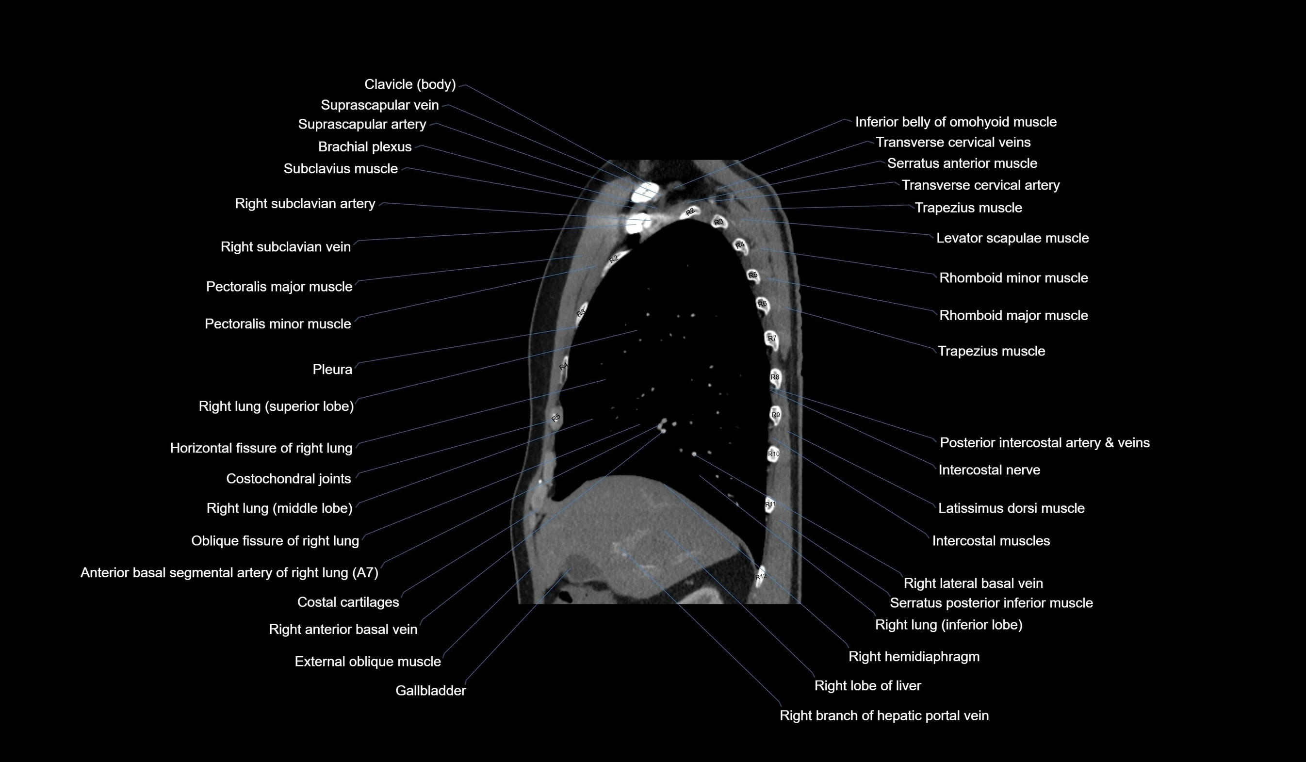 CT chest (thorax) soft tissue window labelled sagittal cross sectional anatomy radiology image-00043.webp